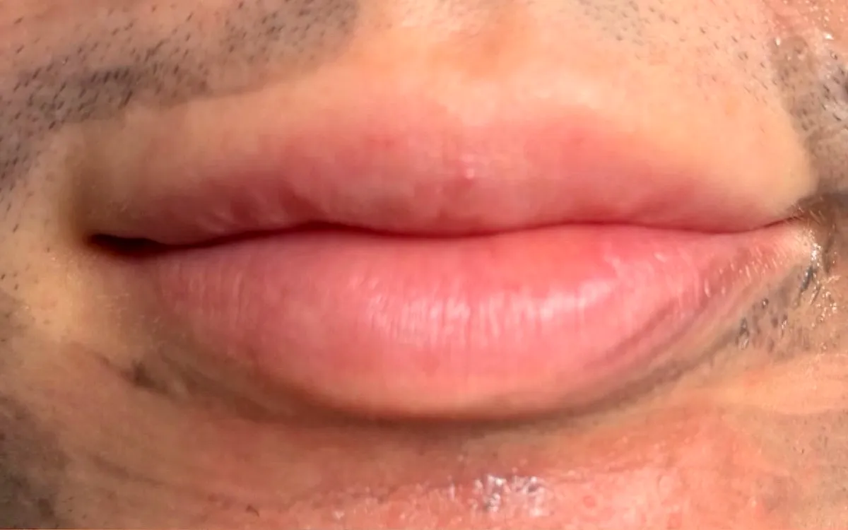 Antes